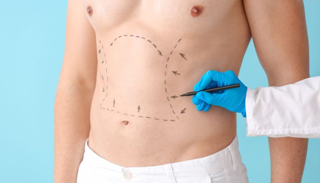 Liposuction Is On The Top Of Male Cosmetic Surgery Wish Lists! Blog Feature Image - Ashbury Cosmetics on Brisbane & the Gold Coast