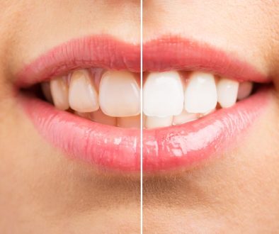 Brighten Your Smile With Cosmetic Teeth Whitening At Ashbury Cosmetics Blog Feature Image - Ashbury Cosmetics on Brisbane & the Gold Coast