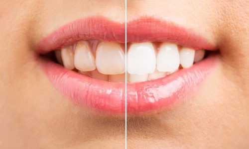 Brighten Your Smile With Cosmetic Teeth Whitening At Ashbury Cosmetics Blog Feature Image - Ashbury Cosmetics on Brisbane & the Gold Coast