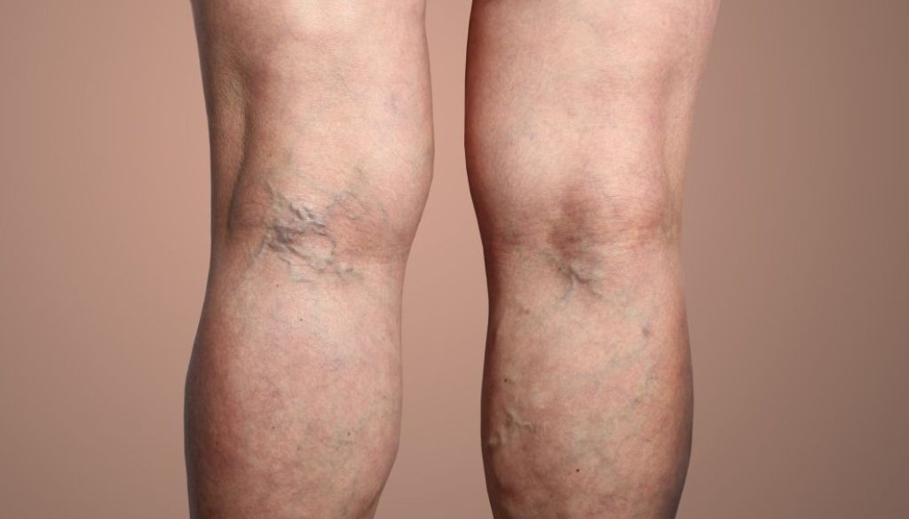 New Breakthrough For Varicose Vein Removal Blog Feature Image - Ashbury Cosmetics on Brisbane & the Gold Coast