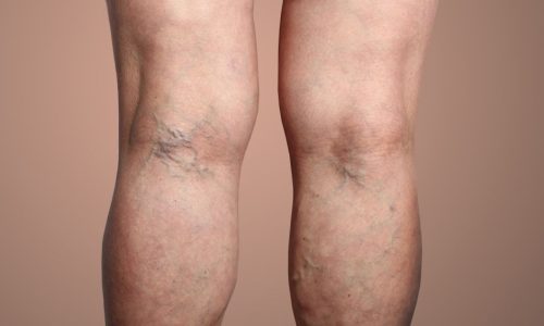New Breakthrough For Varicose Vein Removal Blog Feature Image - Ashbury Cosmetics on Brisbane & the Gold Coast