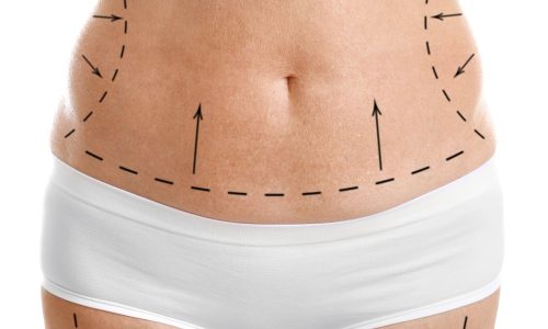Four Tips To Make Your Liposuction Treatment More Effective Blog Feature Image - Ashbury Cosmetics on Brisbane & the Gold Coast