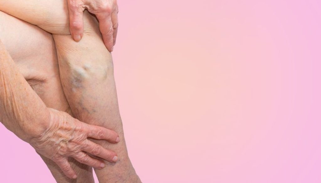 What Is Causing My Varicose Veins? Blog Feature Image - Ashbury Cosmetics on Brisbane & the Gold Coast