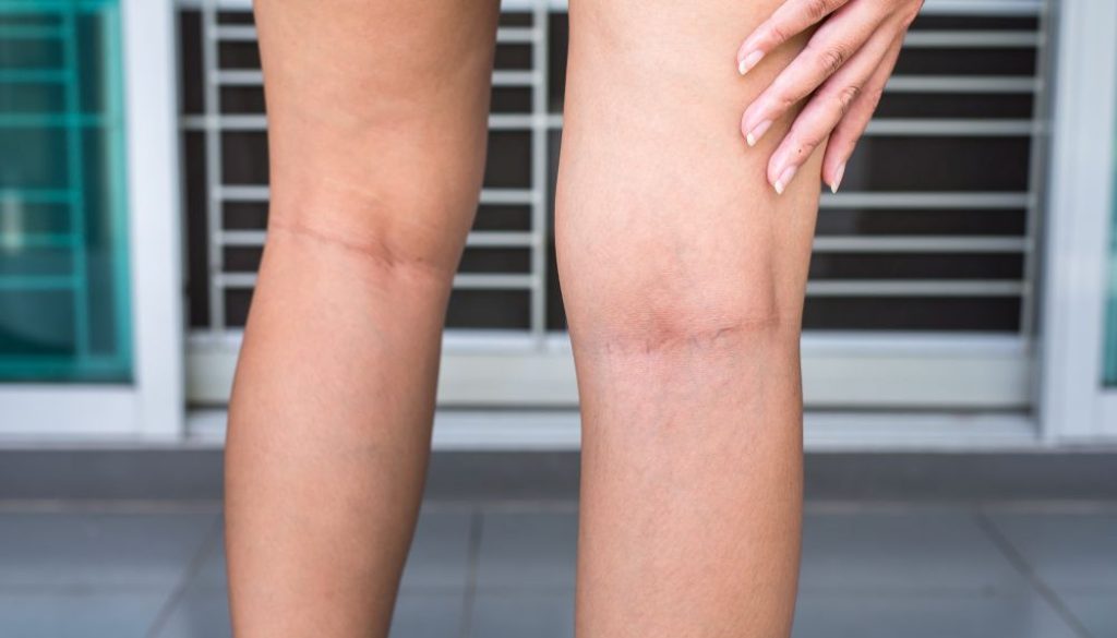 Treating Your Recurring Varicose Veins After Surgery Blog Feature Image - Ashbury Cosmetics on Brisbane & the Gold Coast