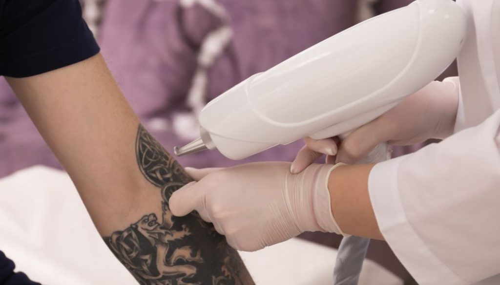 Tattoo Removal Has Doubled On The Gold Coast Blog Feature Image - Ashbury Cosmetics on Brisbane & the Gold Coast