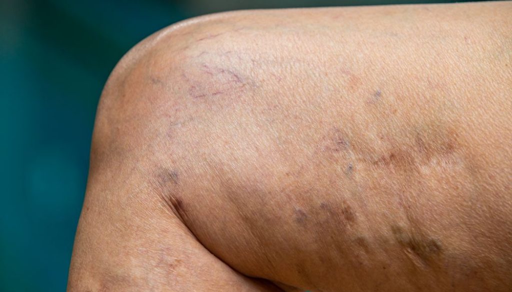 Varicose Veins Are Not Just A Cosmetic Problem Blog Feature Image - Ashbury Cosmetics on Brisbane & the Gold Coast
