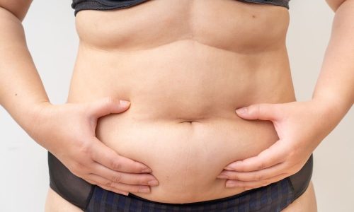Liposuction Can Help Minimise Unwanted Fat Deposits In Men And Women Blog Feature Image - Ashbury Cosmetics on Brisbane & the Gold Coast