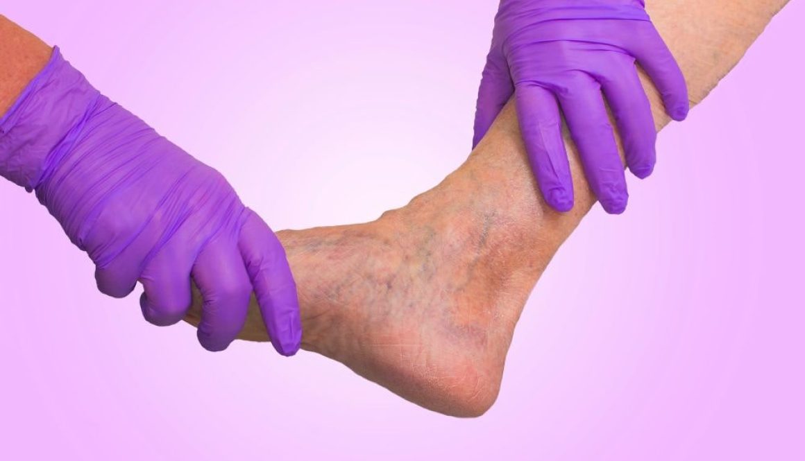 Removing Varicose Veins Isn’t Just A Cosmetic Treatment Blog Feature Image - Ashbury Cosmetics on Brisbane & the Gold Coast
