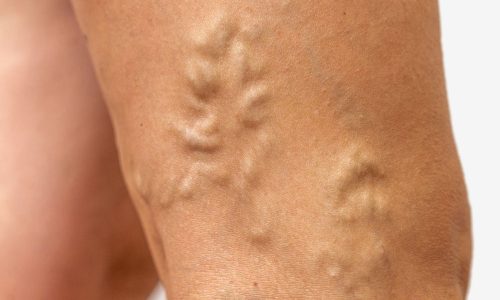 Misconceptions About Varicose Veins Blog Feature Image - Ashbury Cosmetics on Brisbane & the Gold Coast